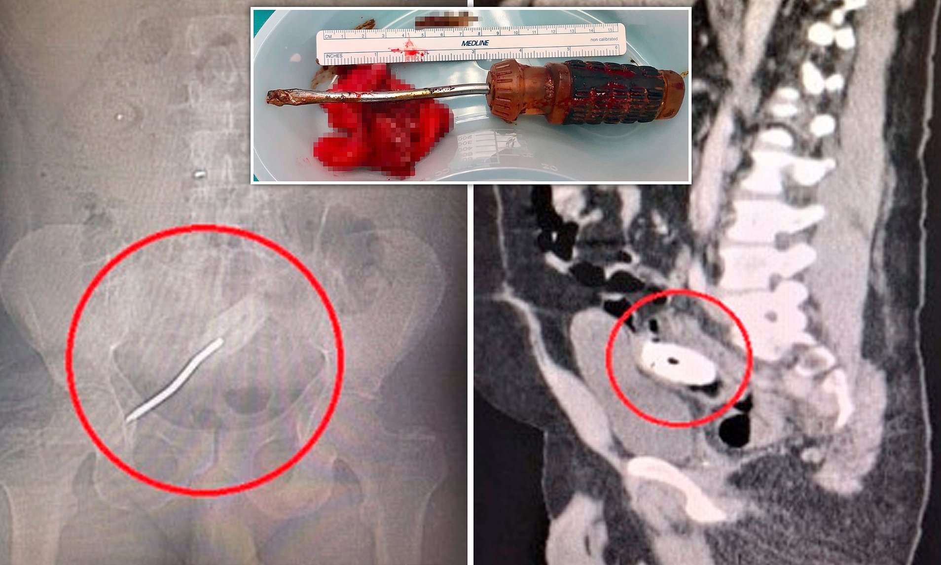 US Doctors Remove 8-inch Screwdriver From Man’s Rectum