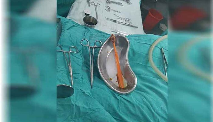 Man swallows 9-inch toothbrush; doctor performs surgery to remove it