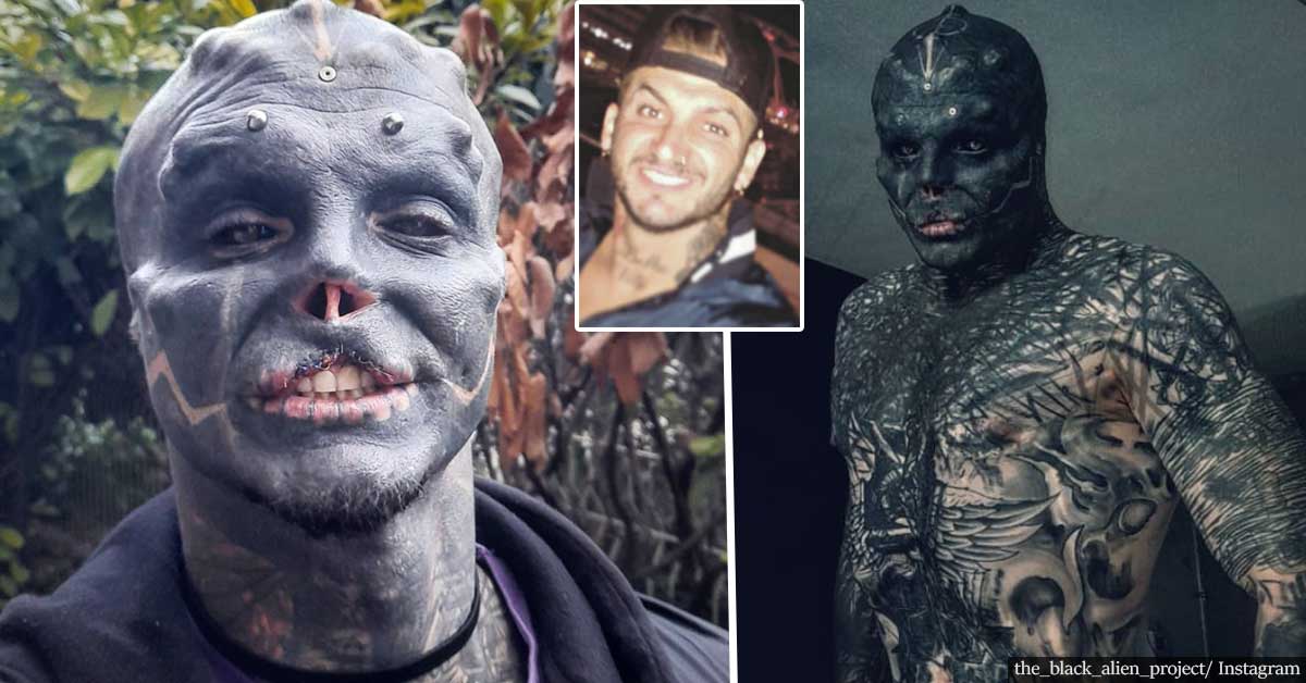 Man Has Nose Removed to Look like A ‘Black Alien’
