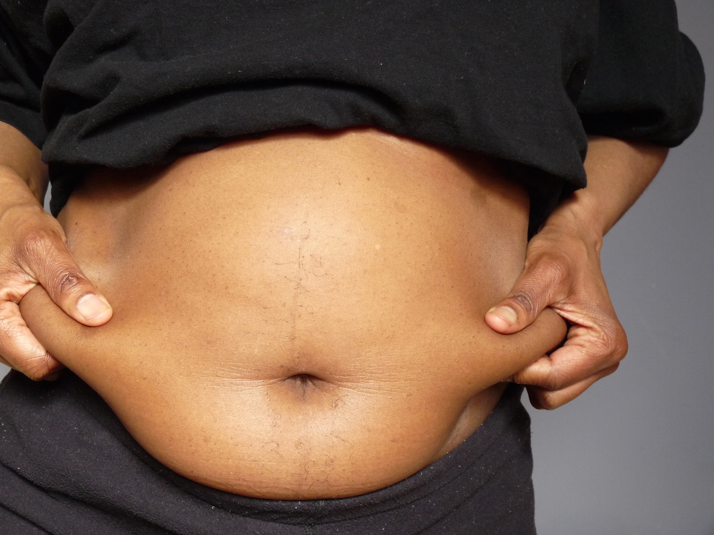 Fat-Shaming is a ‘Legitimate Public Health Issue’