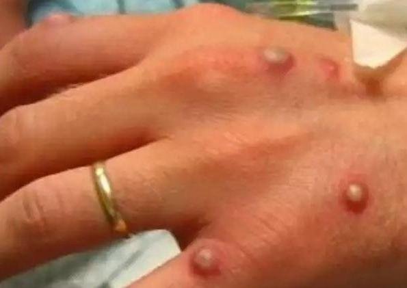 More than 200 contacts tracked in US for rare monkeypox disease