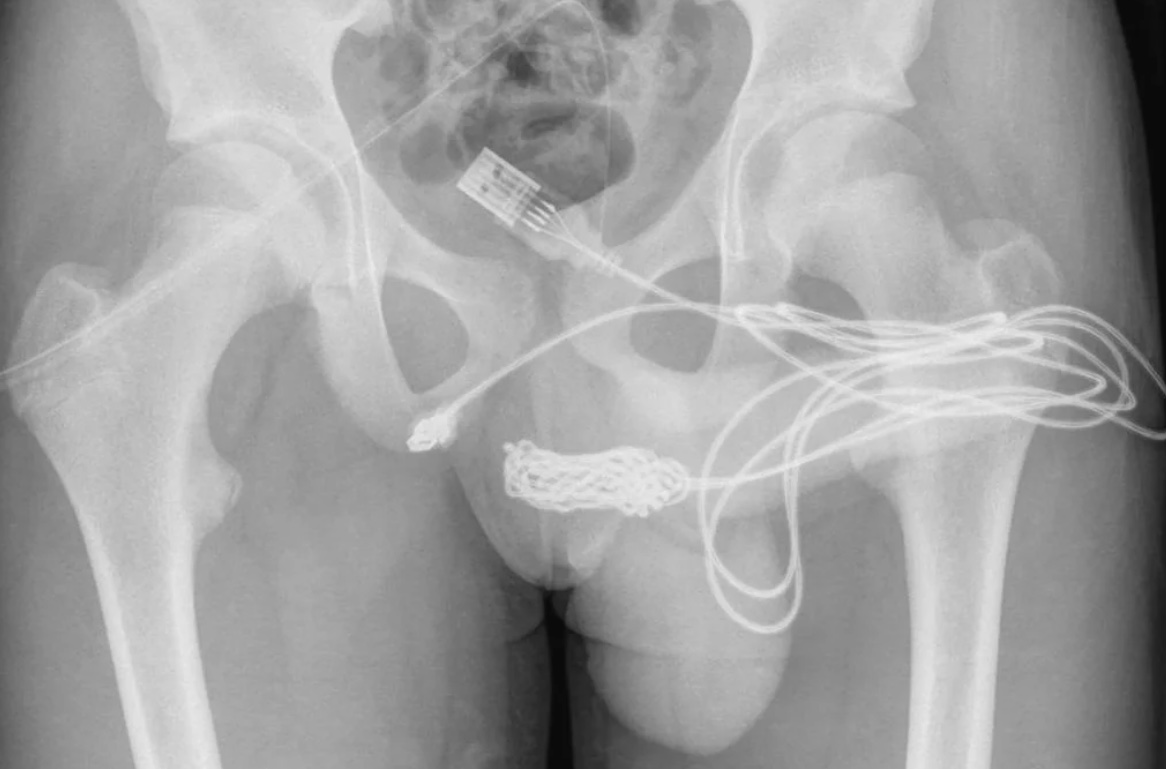 UK teen rushed to emergency surgery after usb cord stuck in his urethra