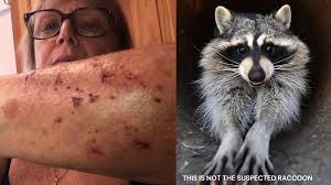 Massachusetts woman bitten by a Raccoon while hanging Christmas lights