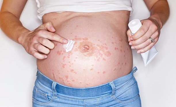 British woman found out she was allergic to her own baby