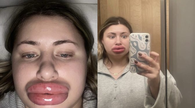 Woman goes viral after severe allergic reaction to lip fillers