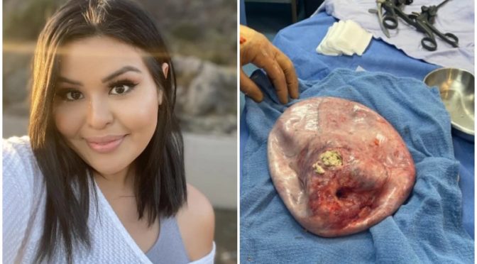 20lb tumor with teeth and hair found inside woman’s ovary