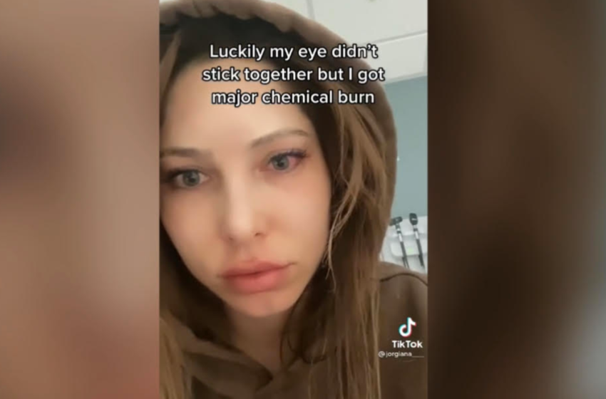 Tik Toker suffered chemical burn after using nail glue instead of eye drops
