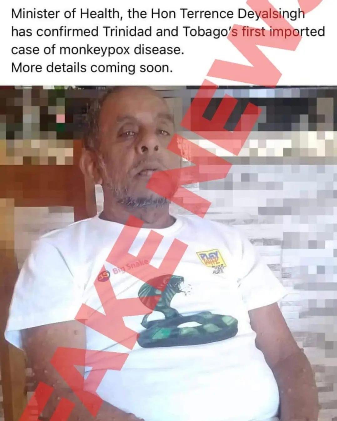 MoH slams claims of MonkeyPox in viral photo as fake news