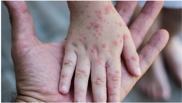 No cases of monkeypox in T&T