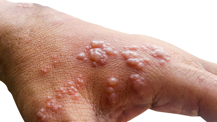 Monkeypox Has Been Added To T&T’s List Of Dangerous Infectious Diseases