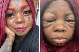Woman who tattooed her eyeballs purple is now losing her sight