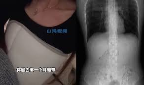Woman broke her ribs while coughing after eating spicy food