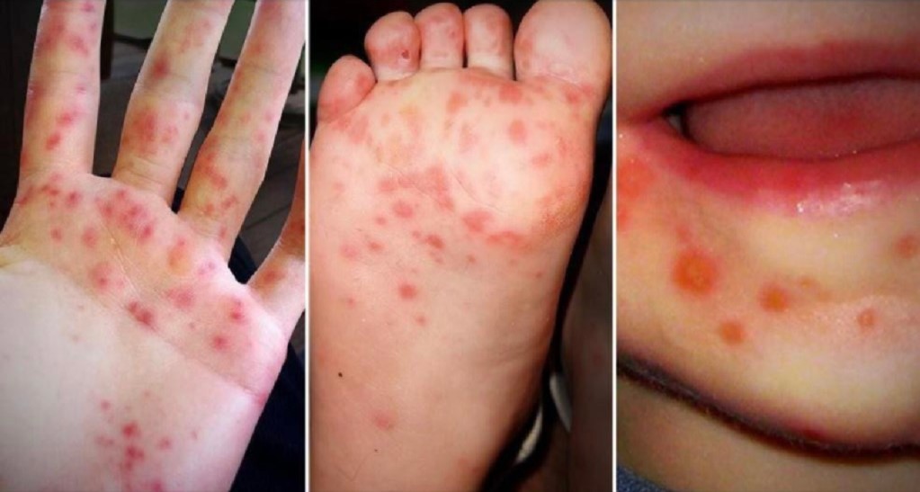 Student at Carenage Primary School quarantined with hand, foot and mouth disease