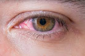 Coronavirus strain linked to pink eye infections in Florida