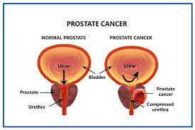 Prostate Cancer Indentified As Leading Cancer Among Males Over Forty Years