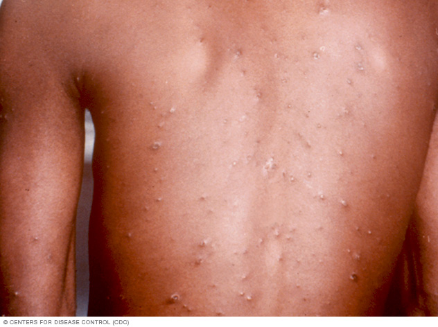 Health Ministry Confirms Chickenpox Virus At Five Rivers Secondary School