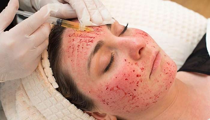 Three women contract HIV after receiving a “vampire facial”